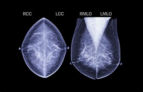 Women age 50-74 should receive screening mammography every 2 years. . Blue cross blue shield mammogram coverage